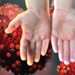 দেশে হামের প্রকোপ বাড়ছে- ২৪ ঘণ্টায় আরও ৫ জনের মৃত্যু